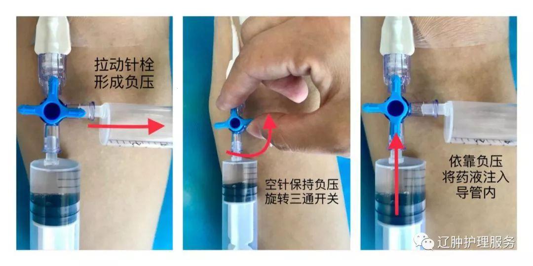 “PICC肿胀”揭秘：笑谈原因与对策